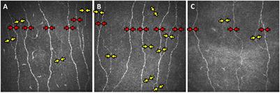 Association of Cerebral Ischemia With Corneal Nerve Loss and Brain Atrophy in MCI and Dementia